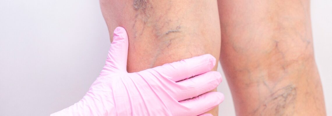 Cuidado de varizes além da estética